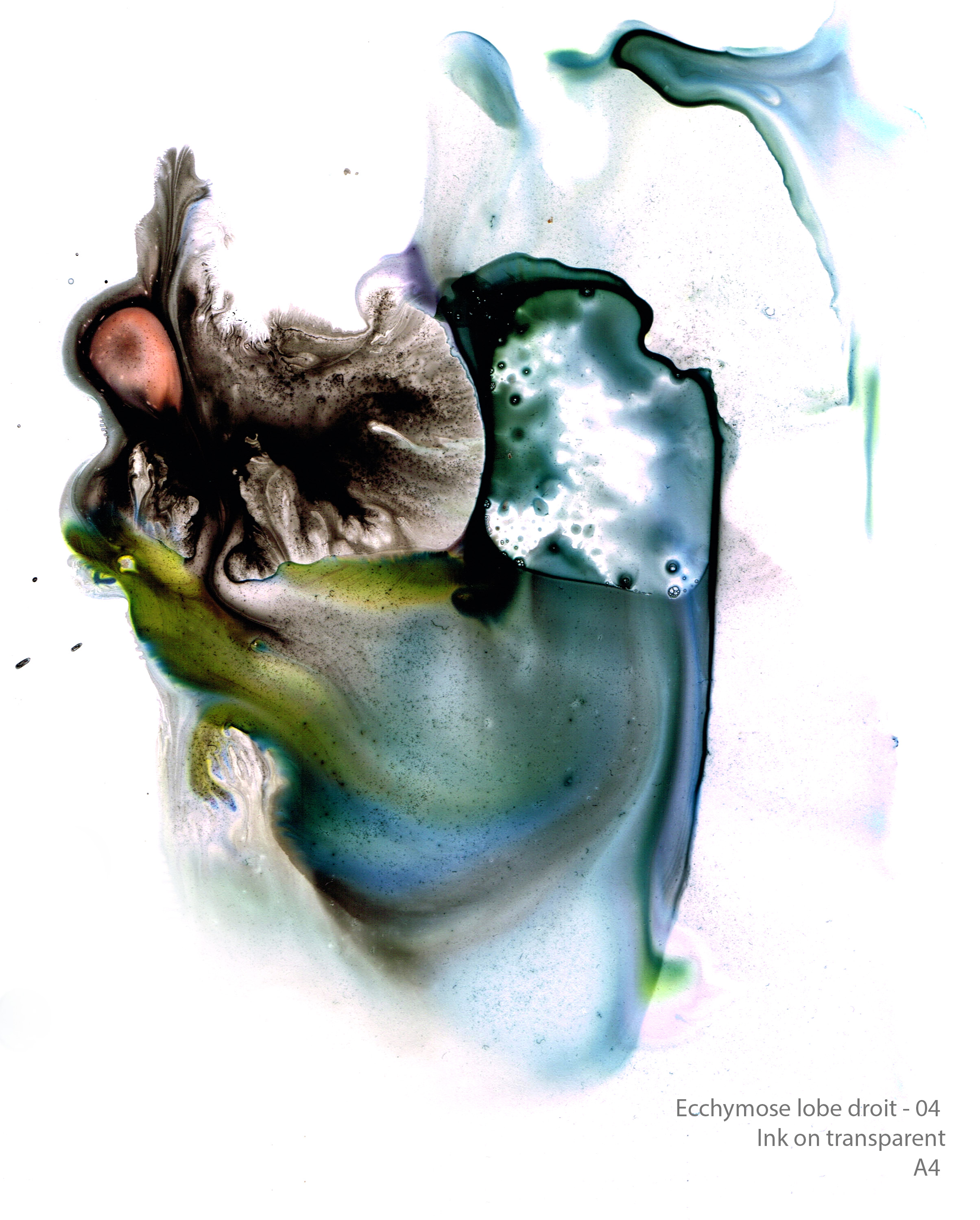 Ecchymose lobe droit 04
